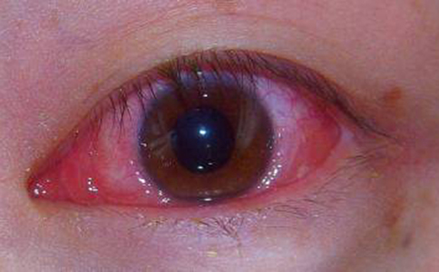 预防红眼病避开哪两个常见误区